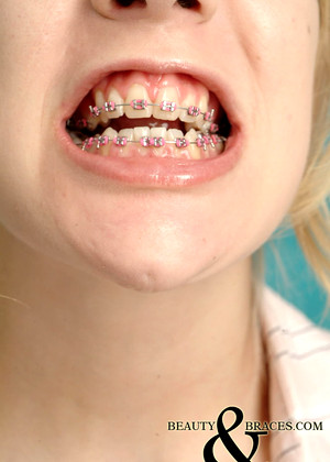 Beautyandbraces Model