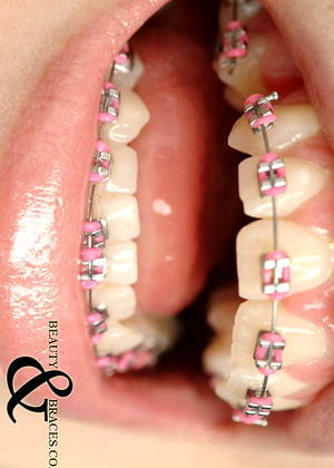 Beautyandbraces Model